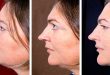 Double Chin: What It Is, What Causes It