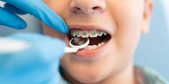 Braces And Orthodontics: When Is The Right Time For Your Child?