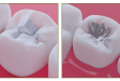 The Art Of Achieving Natural‑Looking Composite Fillings